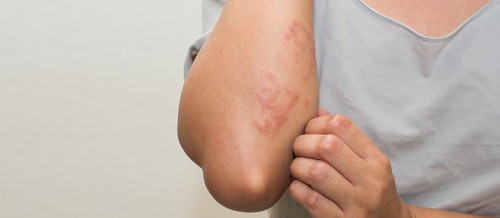 Dermatologiya, Dərinin allergik xəstəlikləri, Dermatoloji xəstəliklə, Dermokosmetik prosedurlar