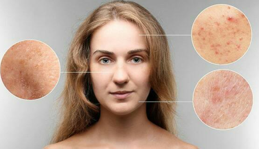 Dermatologiya, Dəri xəstəlikləri, Dermatoloji, Aknenin müalicəsi, Dermatoveneroloq