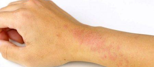 Dermatologiya, Dərinin allergik xəstəlikləri, Dermatoloji xəstəliklə, Dermokosmetik prosedurlar