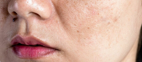 Dəri xəstəlikləri haqqında məlumat, Dərinin virus xəstəlikləri, Dərinin allergik xəstəlikləri, allergik dəri xəstəlikləri