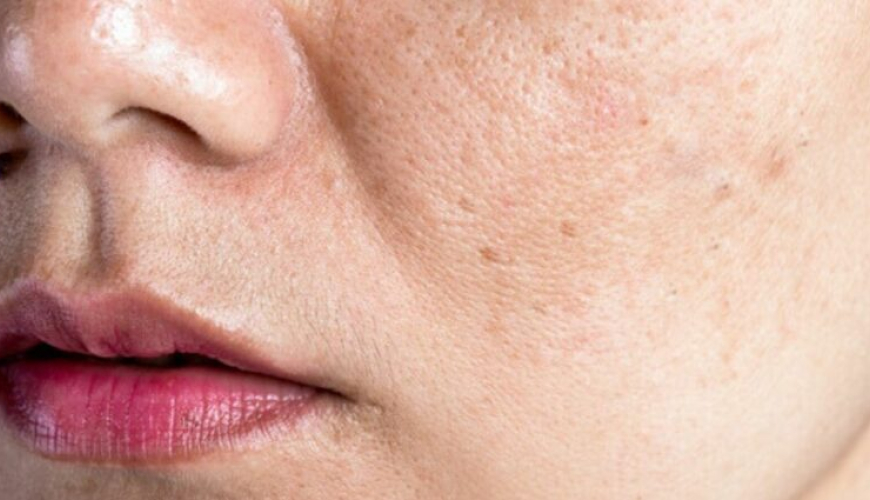 Dəri xəstəlikləri haqqında məlumat, Dərinin virus xəstəlikləri, Dərinin allergik xəstəlikləri, allergik dəri xəstəlikləri