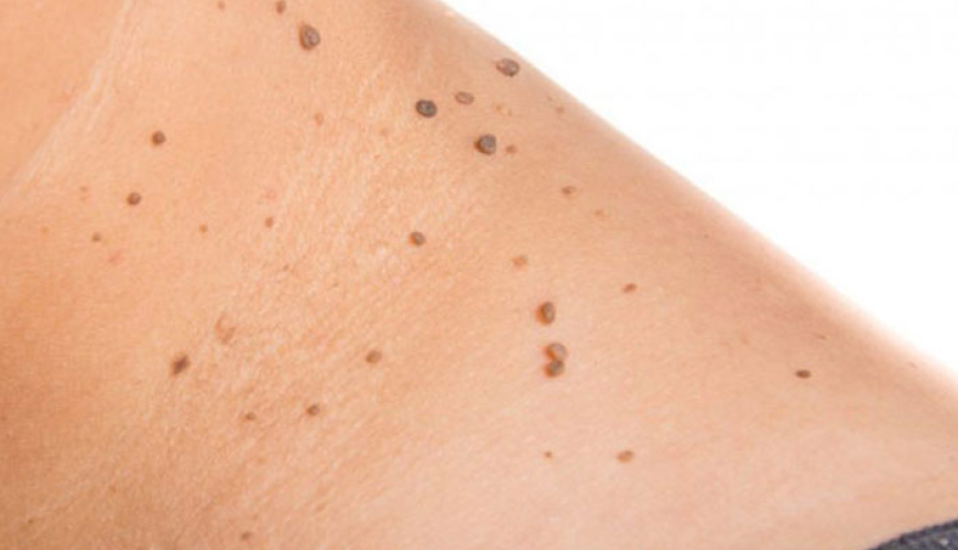 Dəri xəstəlikləri haqqında məlumat, Dərinin virus xəstəlikləri, Dərinin allergik xəstəlikləri, allergik dəri xəstəlikləri