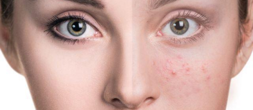 Dermatokosmetik prosedurlar, Dermatoloq, mezoterapiya, Üzdə səpgilər, Akne