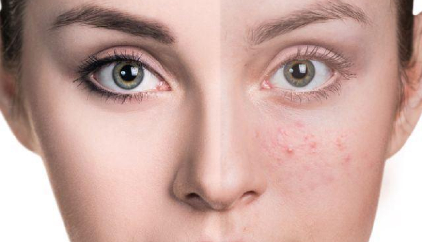 Dermatokosmetik prosedurlar, Dermatoloq, mezoterapiya, Üzdə səpgilər, Akne