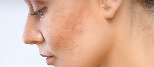 Akne, Aknenin əmələ gəlmə səbəbləri, Qoturluq, Ekzema, Demodeks