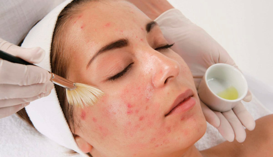 Saç mezoterapiyası, saç tökülməsi, Saç Mezoterapiya Proseduru, Saç mezoterapiya seansı, Saç Mezoterapiyasının Faydaları