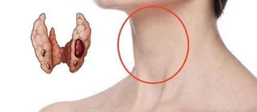 Endokrinoloji xəstəliklər, Zəhərli tənbəl və düyünlü zob xəstəlikləri, zob xəstəlikləri, Qraves xəstəliyi, Düyünlü zob xəstəlikləri