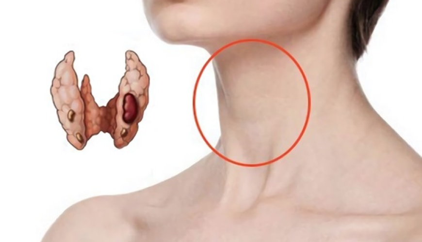 Endokrinoloji xəstəliklər, Zəhərli tənbəl və düyünlü zob xəstəlikləri, zob xəstəlikləri, Qraves xəstəliyi, Düyünlü zob xəstəlikləri