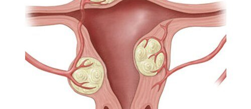Ginekologiya şöbəsi hansı xəstəlikləri müalicə edir, Ginekologiya şöbəsi, Ginekoloji xərçəng