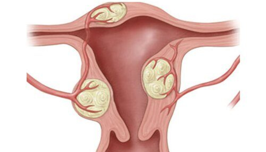 Ginekologiya şöbəsi hansı xəstəlikləri müalicə edir, Ginekologiya şöbəsi, Ginekoloji xərçəng