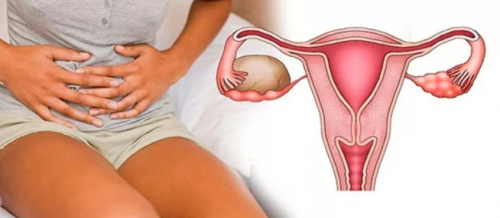 Yumurtalıqda Kistalar, Yumurtalıq kistaları nədir, Yumurtalıq kistlərinin növləri, Yumurtalıq Kistasının Müalicəsi