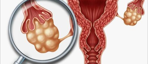 Menstruasiya pozulmaları, qanama və menstruasiya ağrıları, Anormal uşaqlıq qanaxması, Hipermenoreya