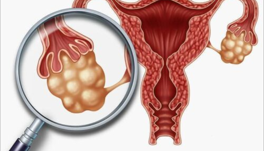 Menstruasiya pozulmaları, qanama və menstruasiya ağrıları, Anormal uşaqlıq qanaxması, Hipermenoreya