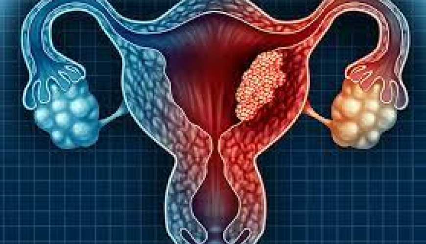 Menstruasiya pozulmaları, qanama və menstruasiya ağrıları, Anormal uşaqlıq qanaxması, Hipermenoreya