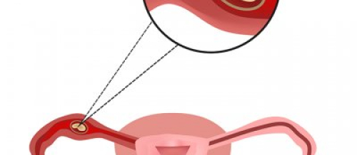 Menstruasiya pozulmaları, qanama və menstruasiya ağrıları, Anormal uşaqlıq qanaxması, Hipermenoreya