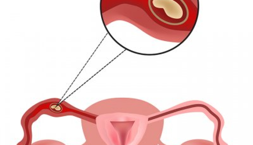 Menstruasiya pozulmaları, qanama və menstruasiya ağrıları, Anormal uşaqlıq qanaxması, Hipermenoreya