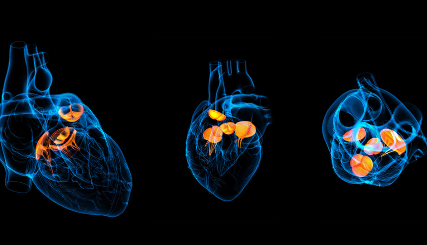 Piylənmənin səbəb olduğu ürək xəstəlikləri, EKQ, EXO-KQ, Ürək-damar sisteminin xəstəlikləri, Ürəyin işemik xəstəliyi