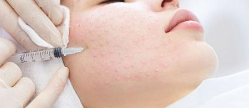 Kosmetologiya nədir,  Kosmetoloji fəaliyyət, Kosmetoloji, karbon pilinqi,  kimyəvi pilinq, Q-switched