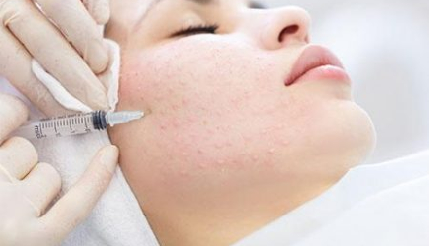 Kosmetologiya nədir,  Kosmetoloji fəaliyyət, Kosmetoloji, karbon pilinqi,  kimyəvi pilinq, Q-switched