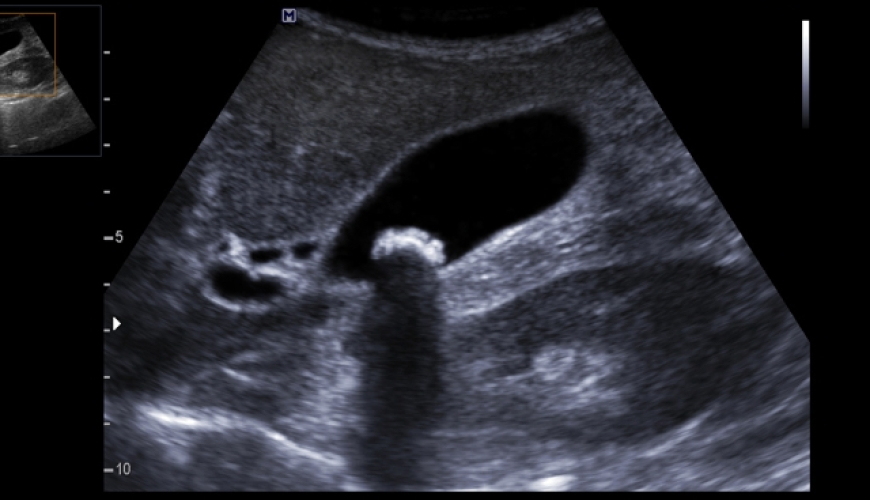Ultrasəs müayinəsi, USM VƏ DOPLEROQRAFİYA, USM-diaqnostika nədir, Süd vəzilərinin USM-i